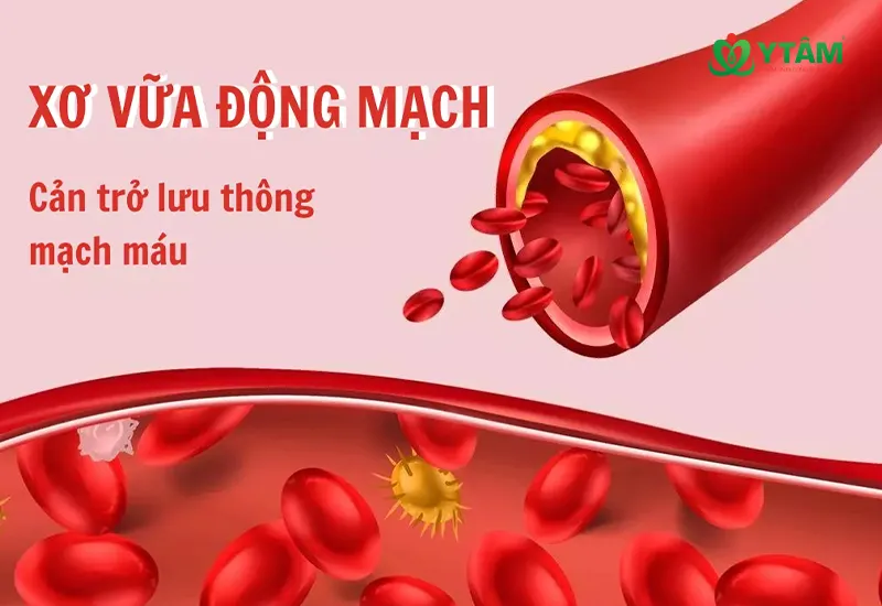 Xơ vữa động mạch: Triệu chứng và cách phòng ngừa