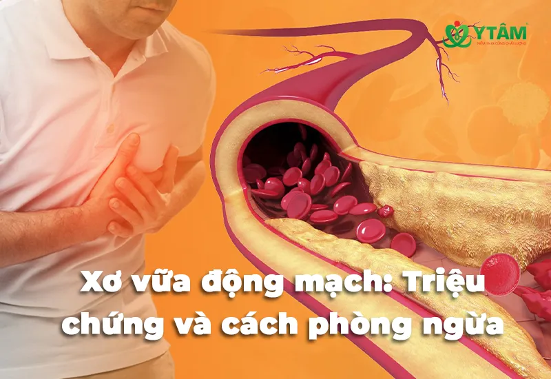 Xơ vữa động mạch: Triệu chứng và cách phòng ngừa